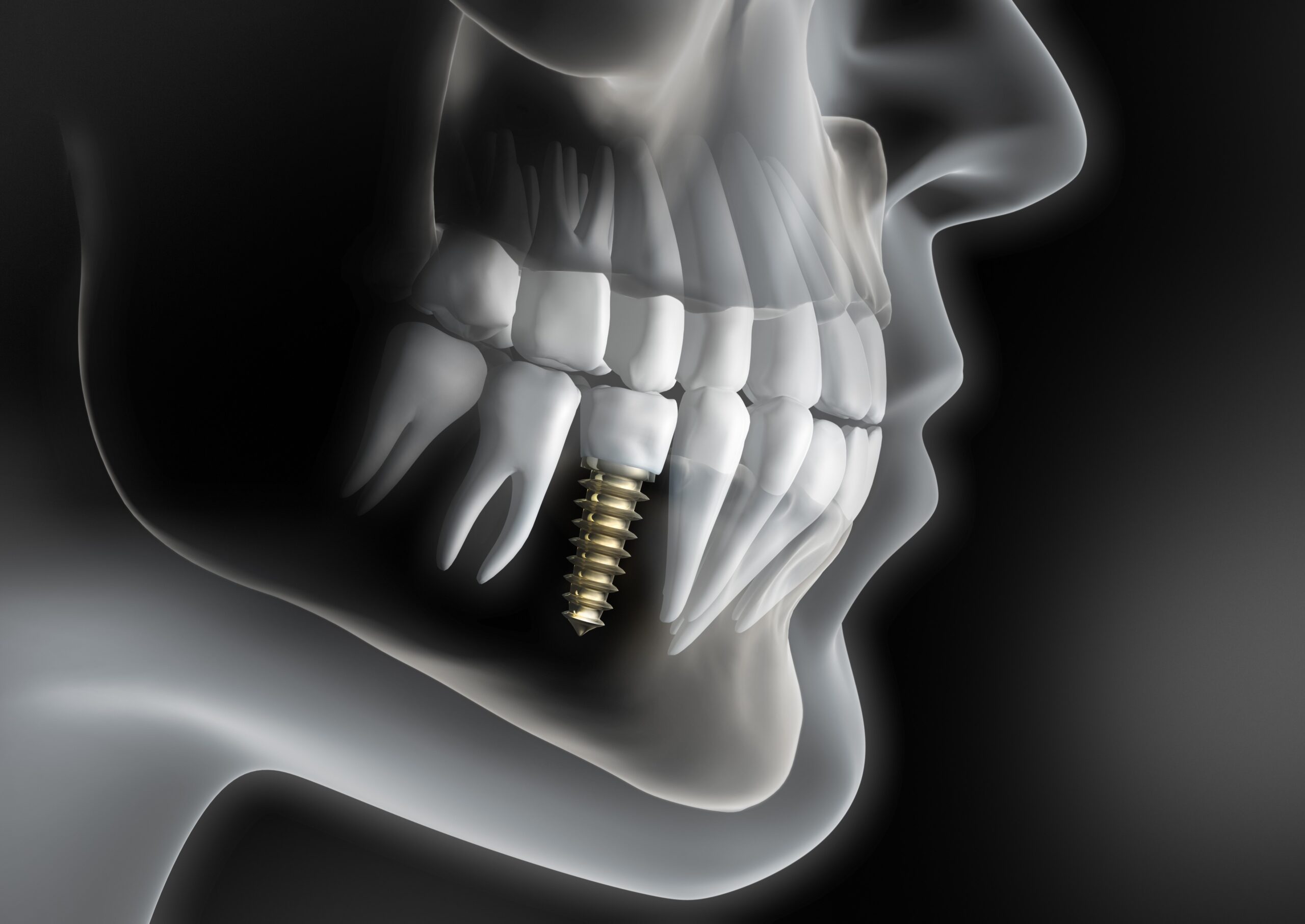 Implantes Dentales E Implantología Maxilofacial En Madrid